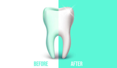 2-beforeAfter-800×463-1-400×232