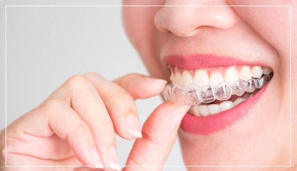 3invisalign_image_3-600×347