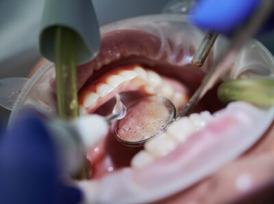 Orthodontist doing professional teeth cleaning in dental clinic.