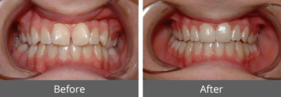 dental_straighting-400×138-1