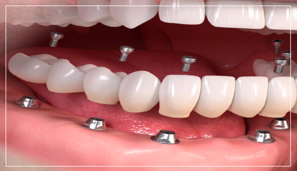 images-implants-2-600×347 (1)