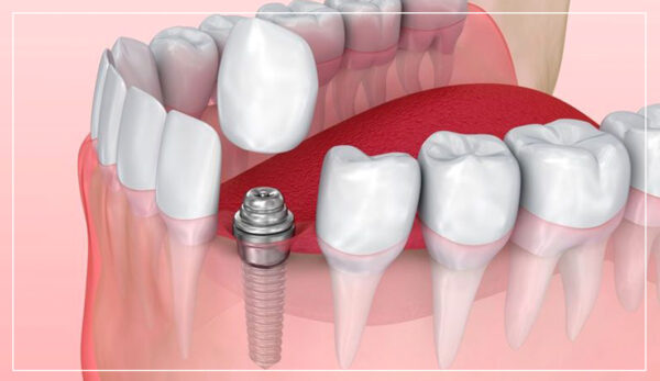 images-implants-600×347